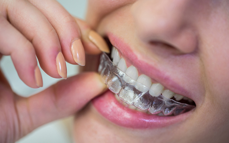 clear aligners